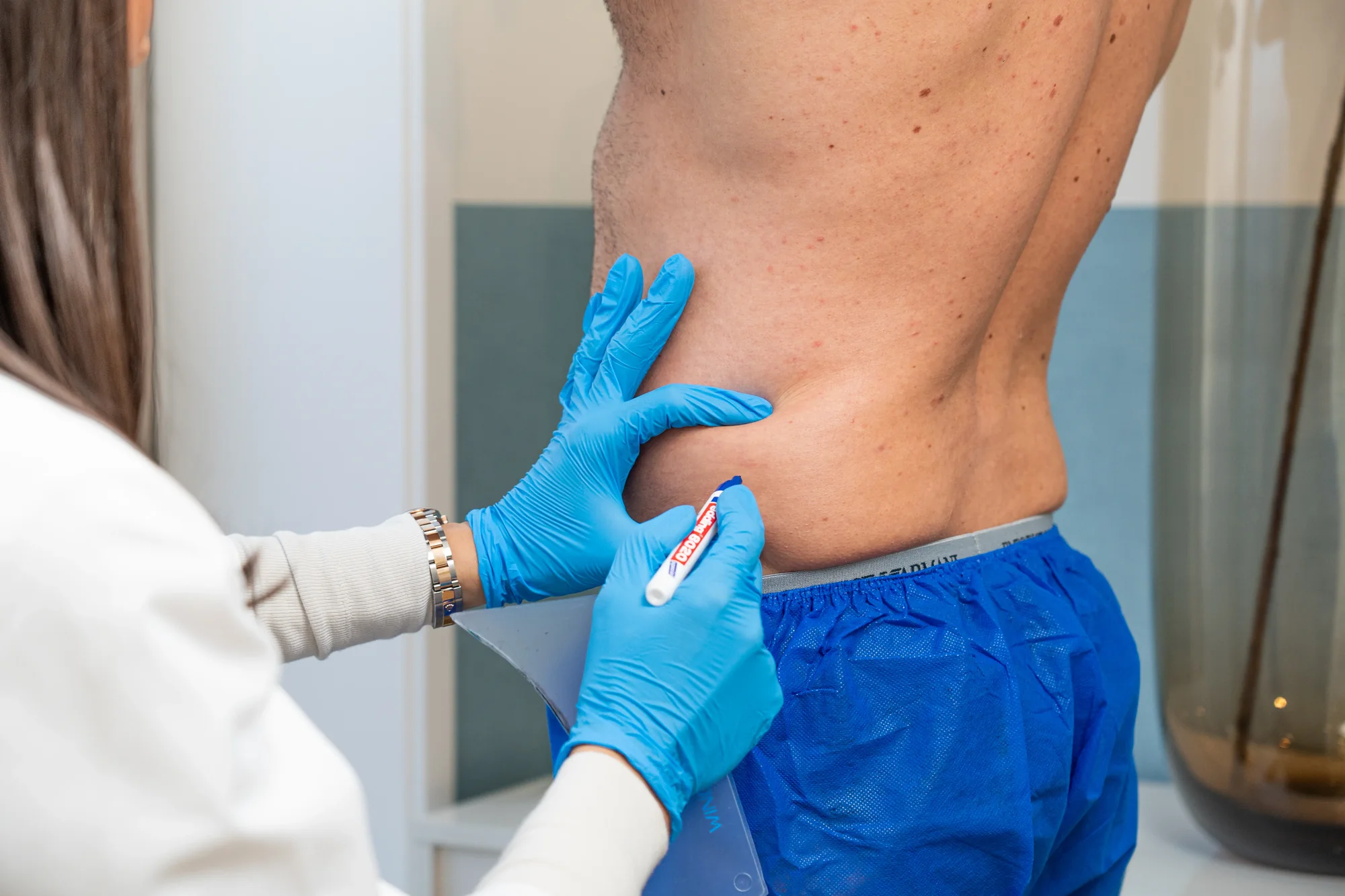 Specialist markeert de love handle voor een cryolipolyse behandeling